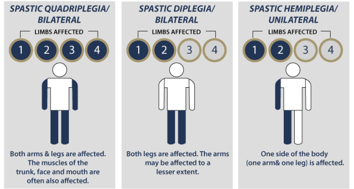 Understanding Cerebral Palsy in Children: Symptoms and Care